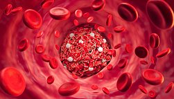 Тромбофлебит