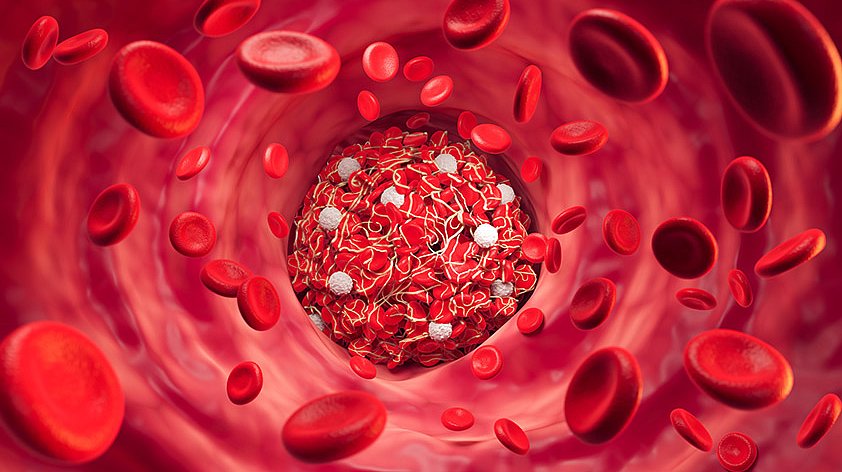 Тромбофлебит