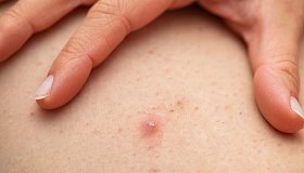 Фолликулит