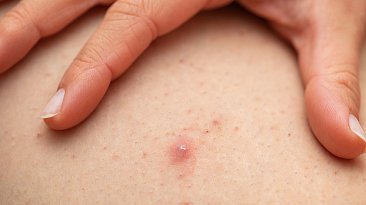 Фолликулит