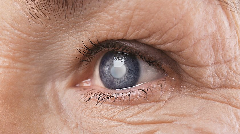 Начальная катаракта: признаки и лечение