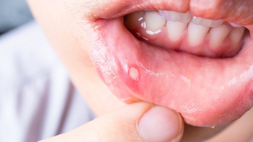 Язвочки во рту на внутренней стороне губы чем лечить