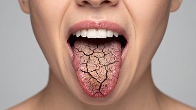 Сухость во рту