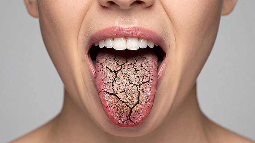 Сухость во рту