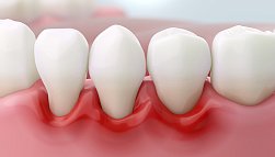 Пародонтит