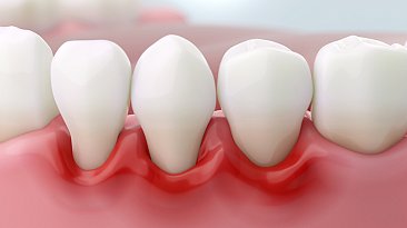 Пародонтит